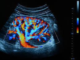 ECODOPPLER RENAL ECODOPPLER RENAL