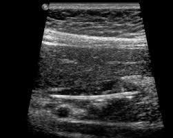 ULTRASSOM DE PARTES MOLES