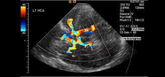 DOPPLER TRANSCRANIANO DOPPLER TRANSCRANIANO