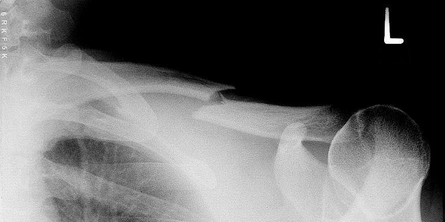 Fracture de clavicule