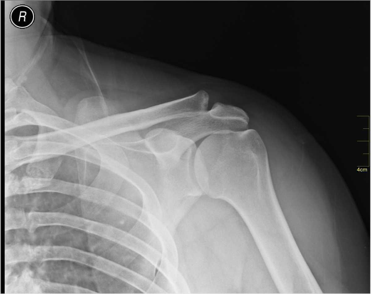 Disjonction acromio-claviculaire