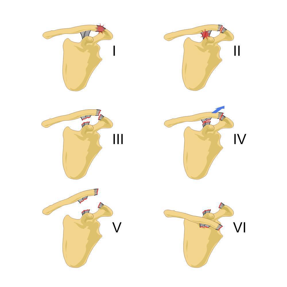 Disjonction acromio-claviculaire