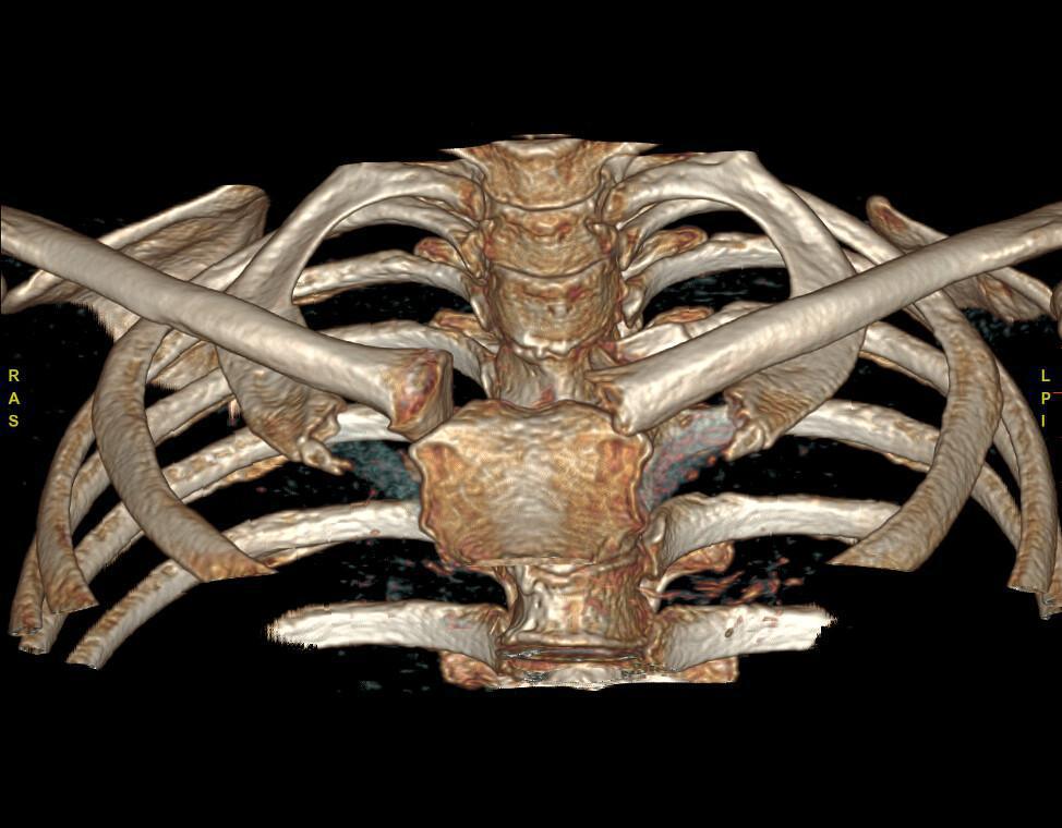 Luxation sterno-claviculaire