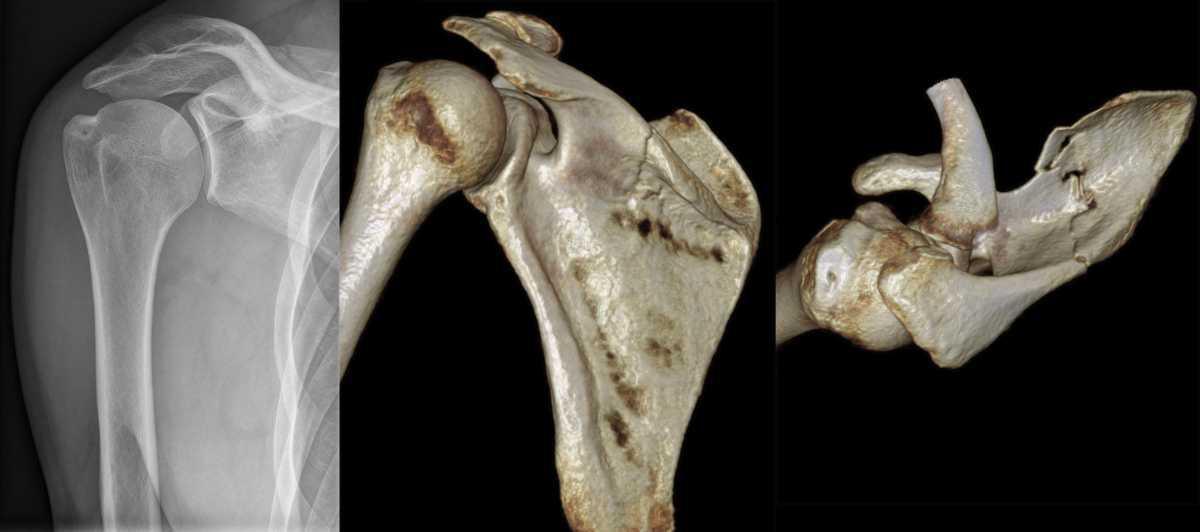 Fracture de la scapula