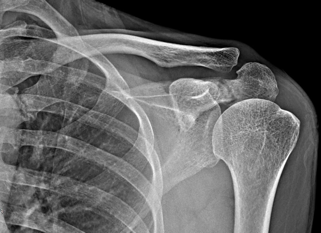 Fracture de l’acromion