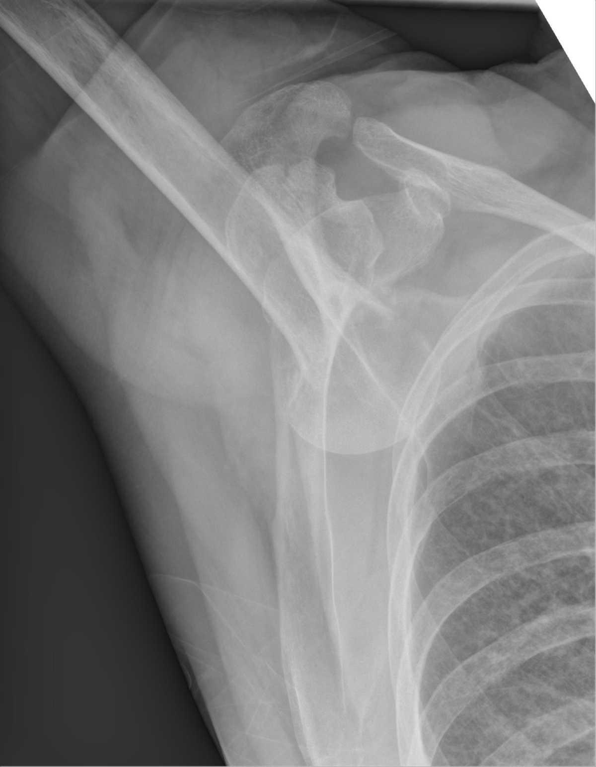 Luxations gleno-humerales Luxations gleno-humerales