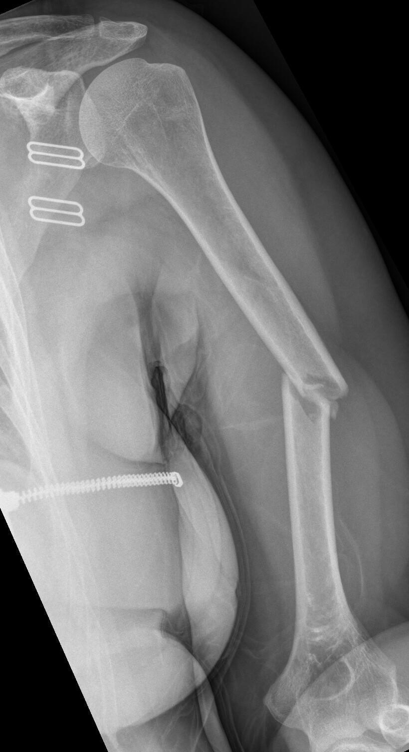 Fracture de la diaphyse humerale Fracture de la diaphyse humerale