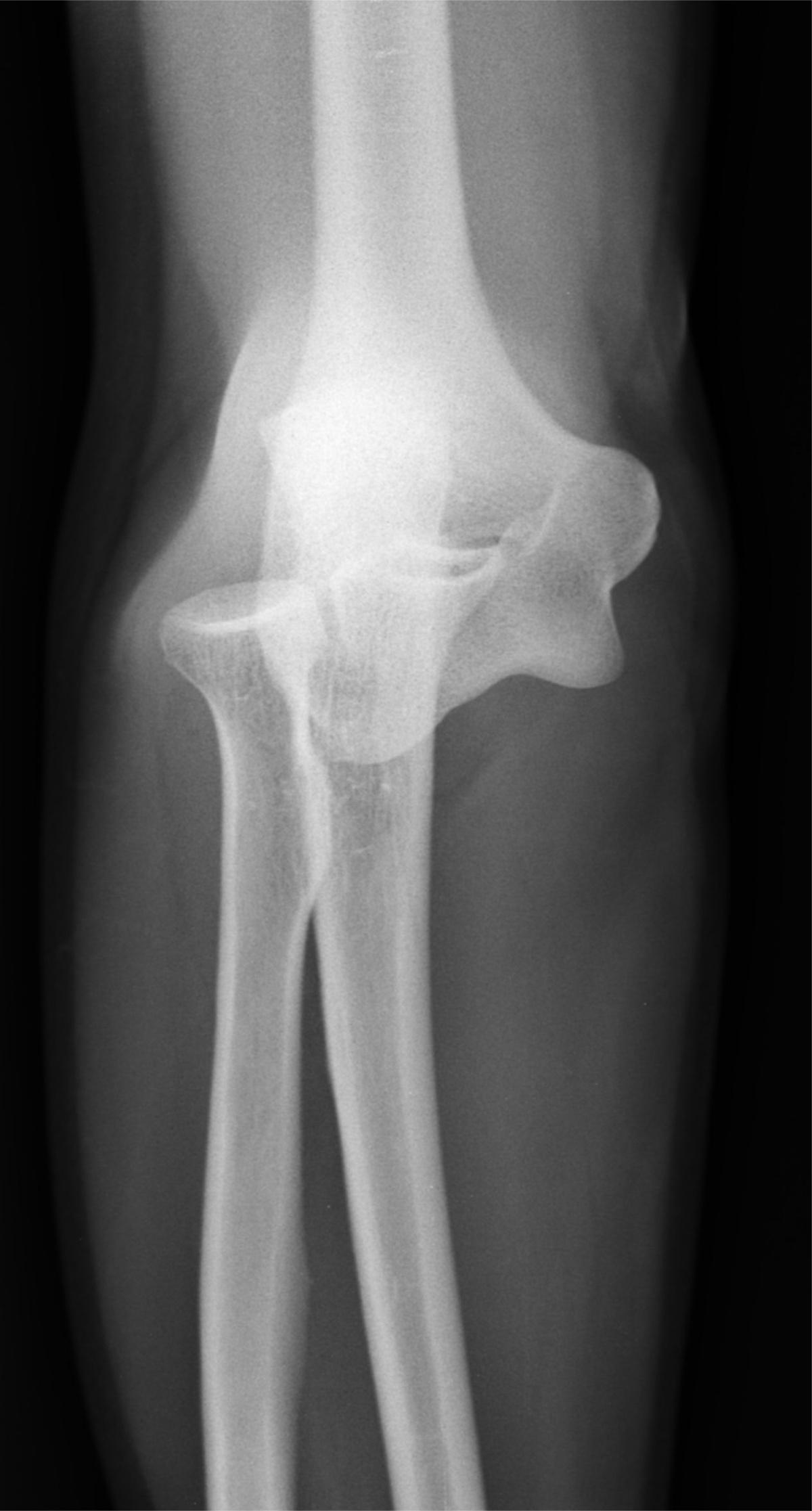 Luxation du coude (sans fracture)