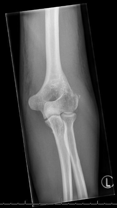 Fracture du coude Fracture du coude
