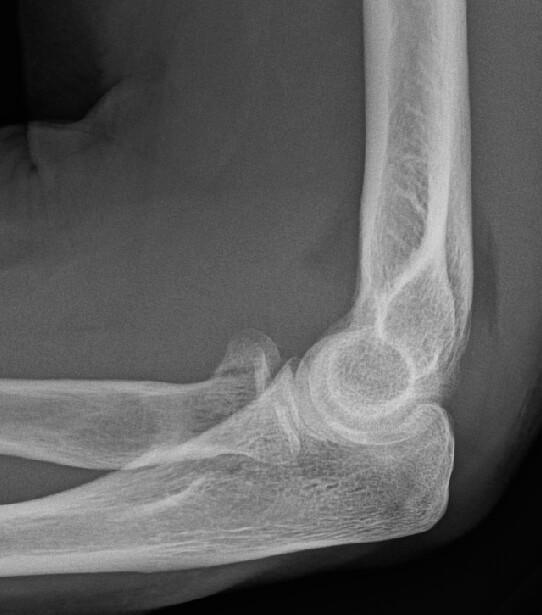 Fracture de la tete radiale Fracture de la tete radiale