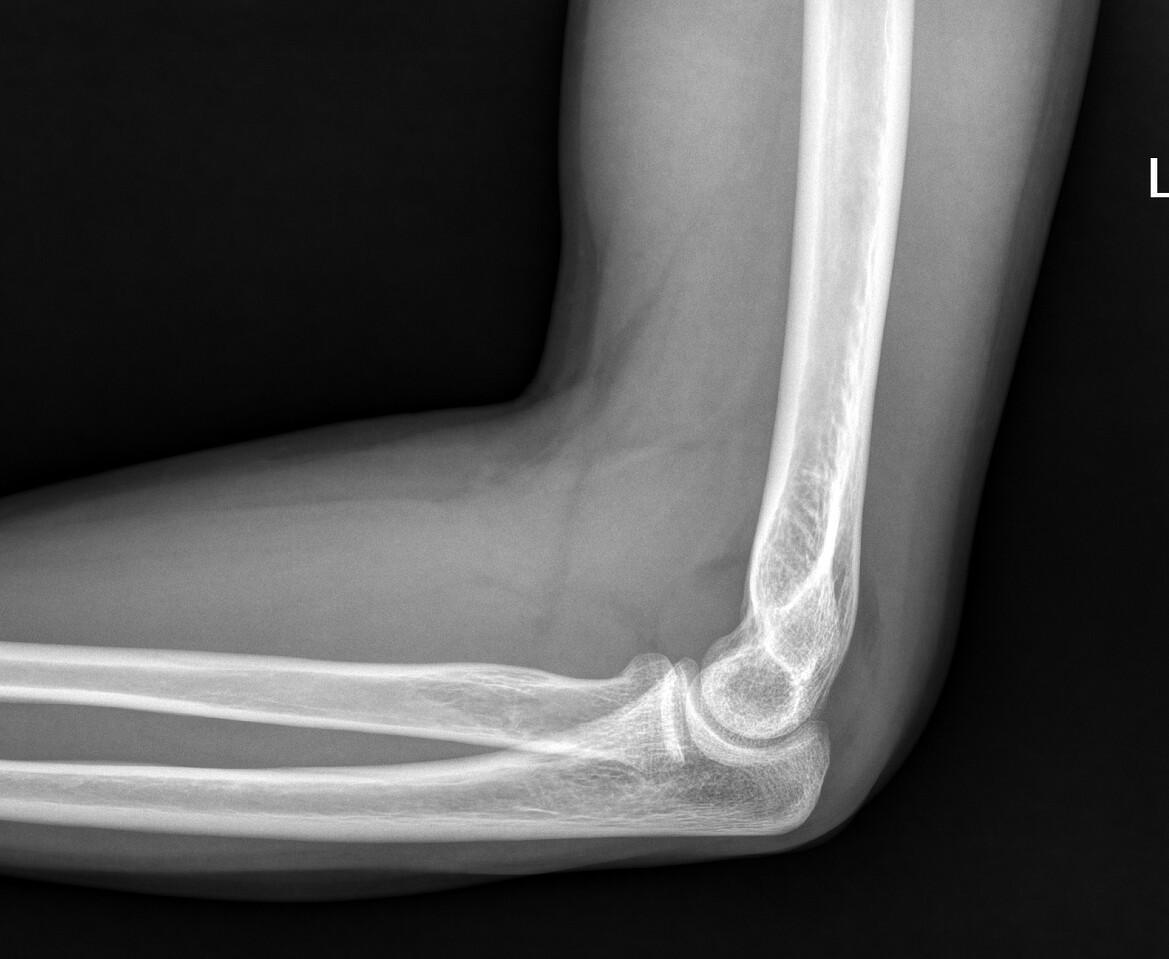 Fracture de la tete radiale Fracture de la tete radiale