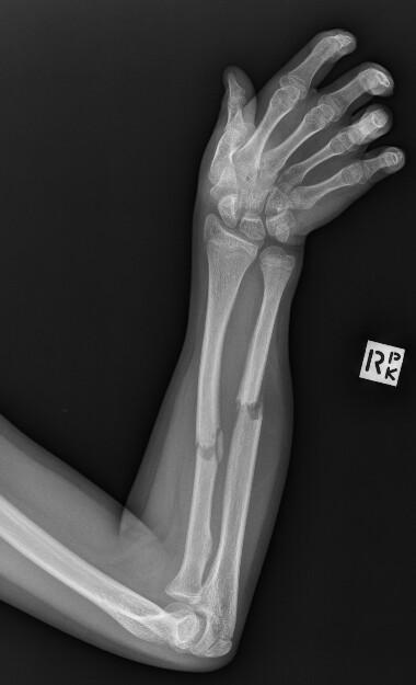 Fracture radius-ulnaire
