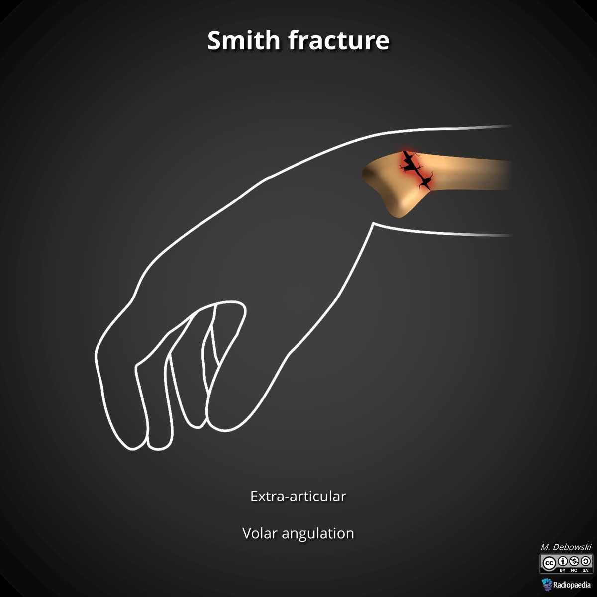 Fracture radius-ulnaire Fracture radius-ulnaire