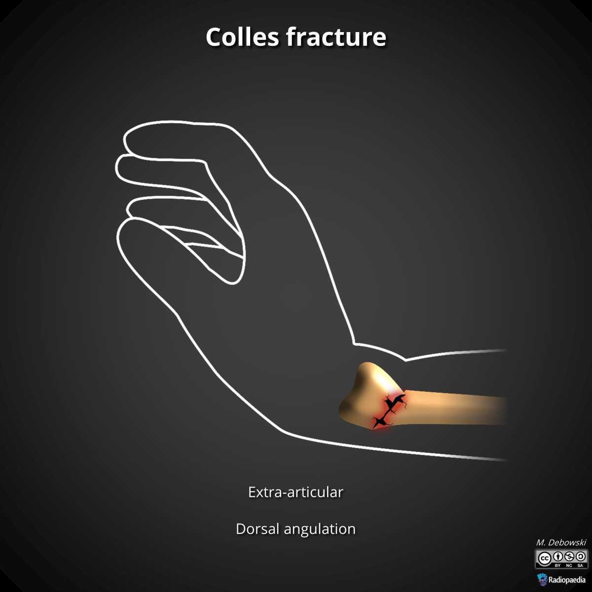Fracture radius-ulnaire