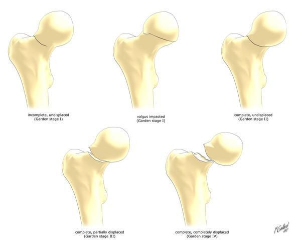 Fracture de l’extremite superieure du femur