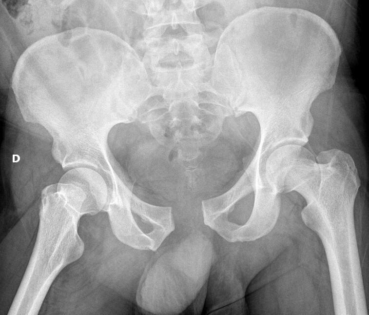 Fracture du bassin Fracture du bassin