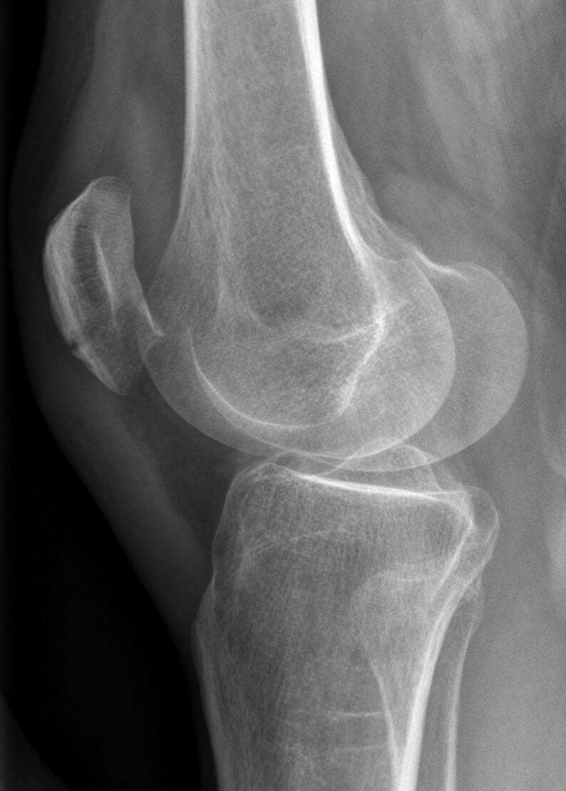 Fracture de patella
