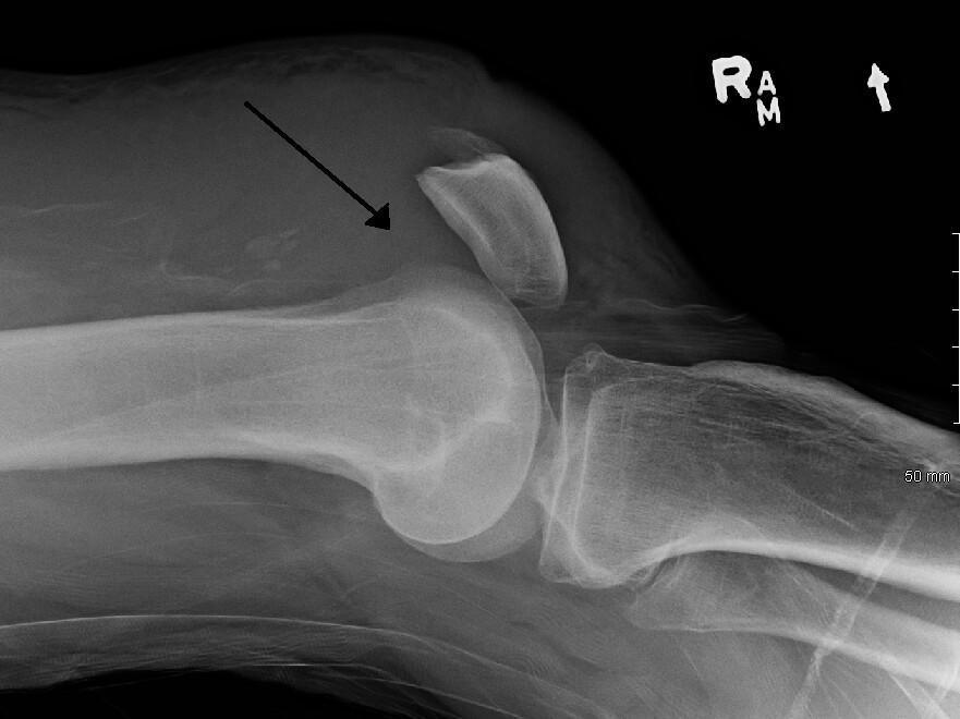 Rupture du tendon quadricipital