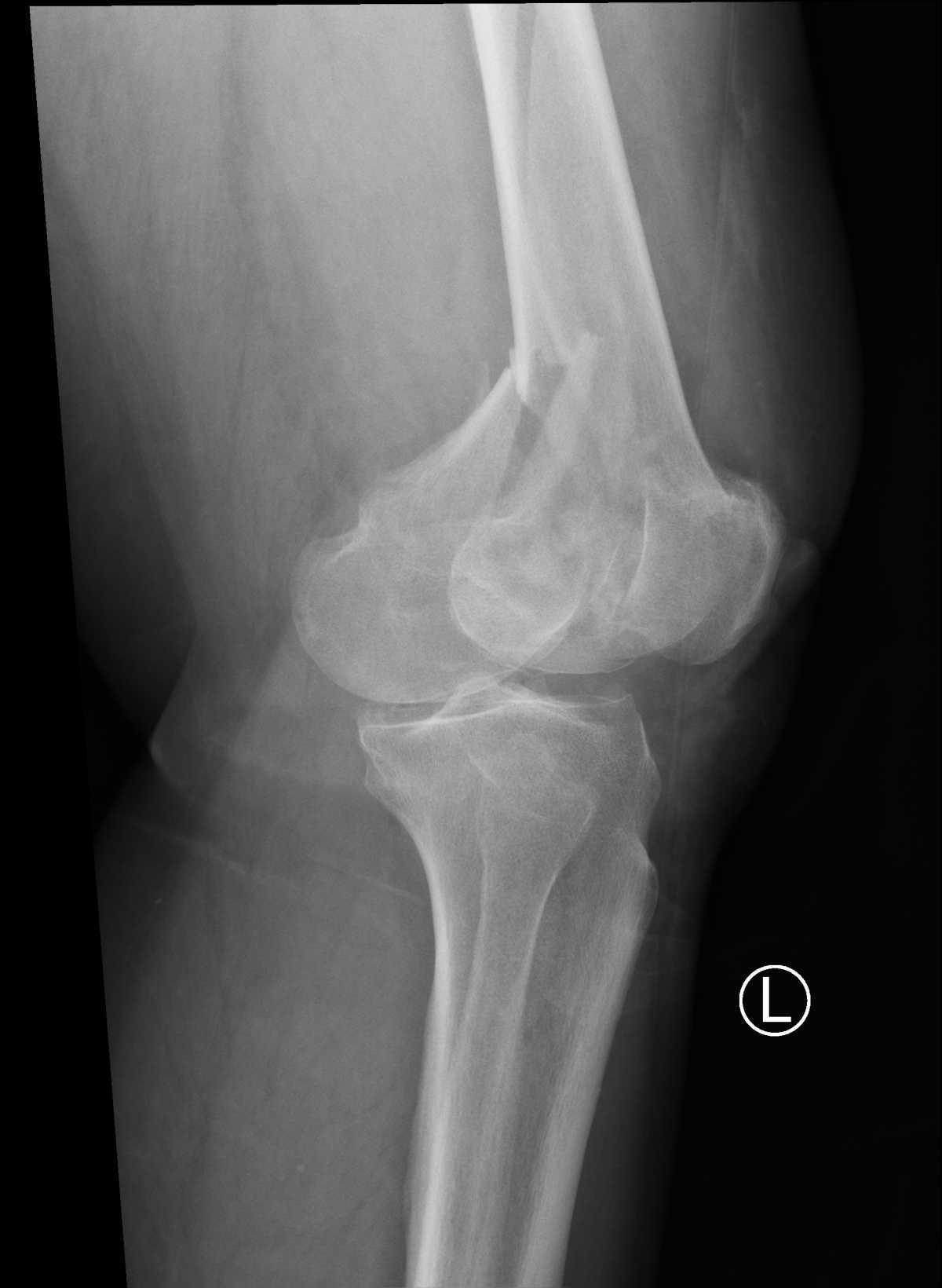 Fracture de l’extremite inferieure du femur