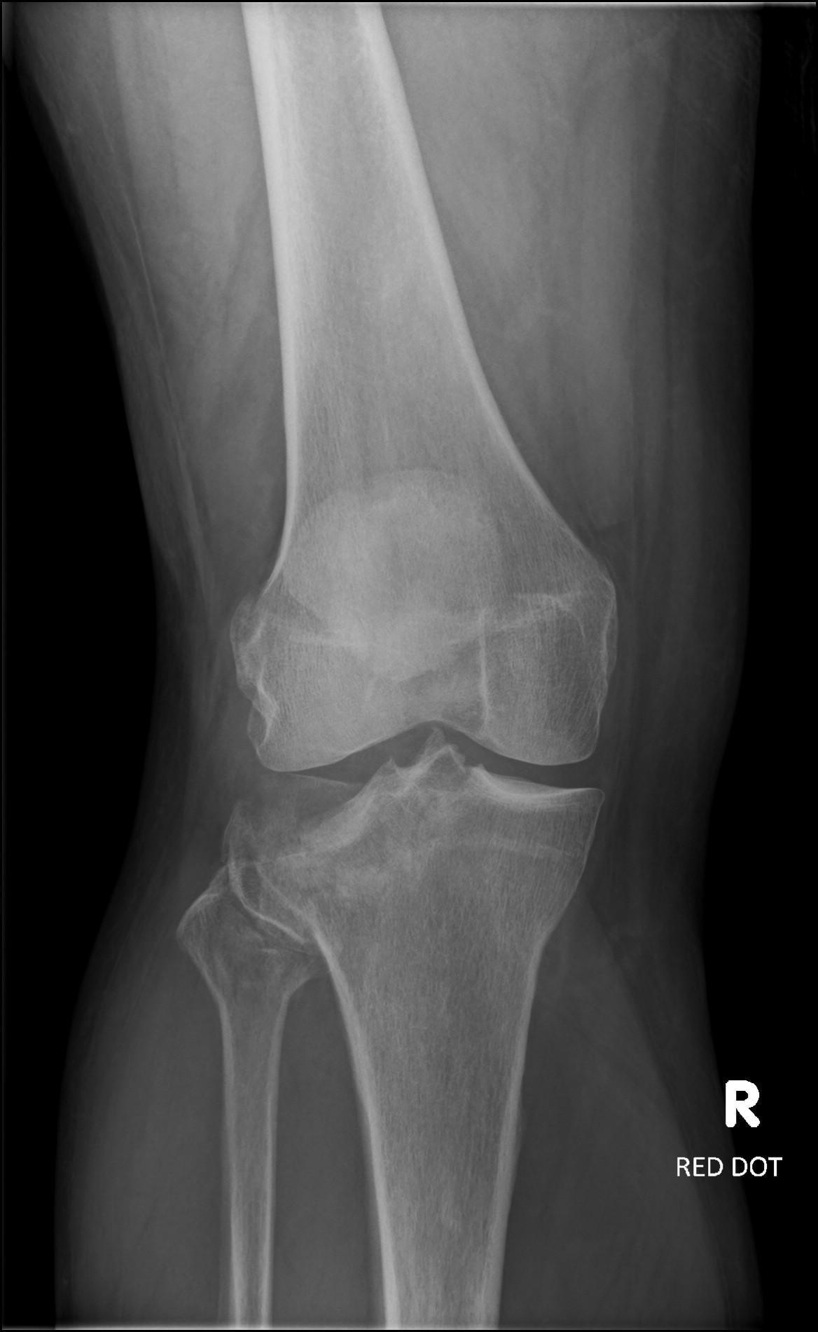 Fracture tibio-fibulaire
