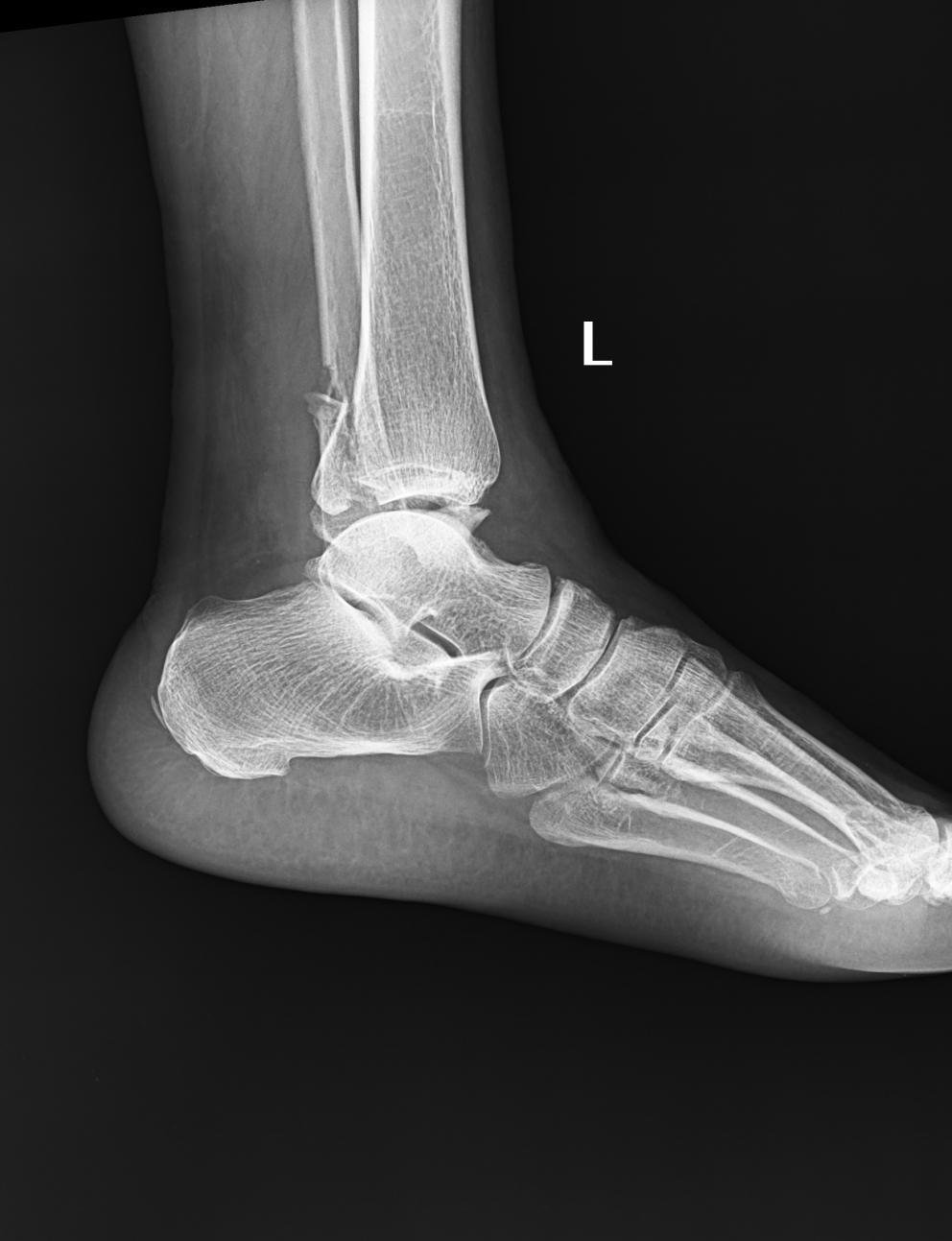 Fractures malleolaires