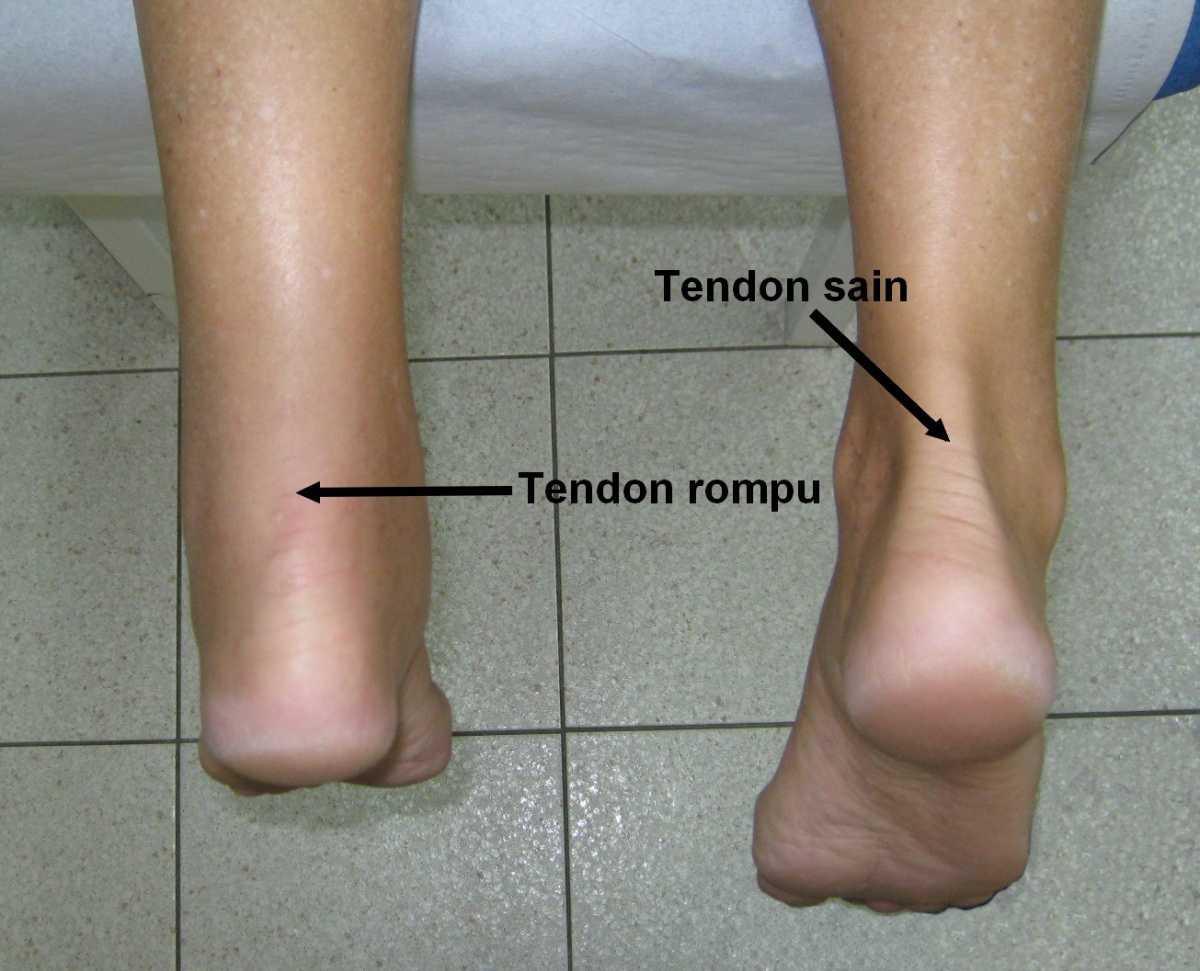 Rupture du tendon d’Achille