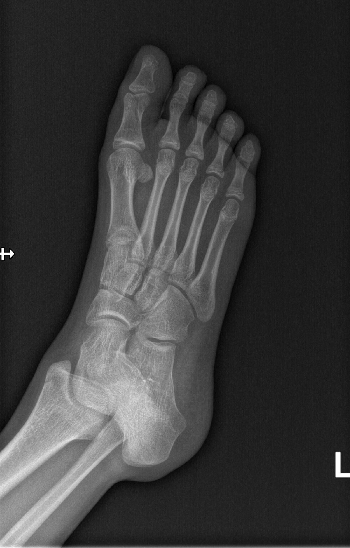 Fracture de phalange