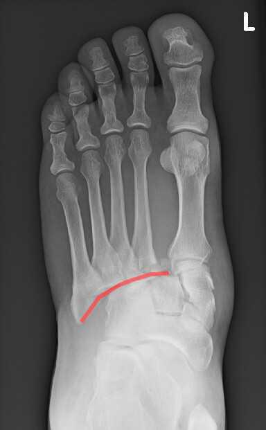 Entorse de Lisfranc Entorse de Lisfranc