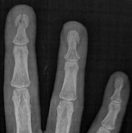 Fractures de phalanges Fractures de phalanges