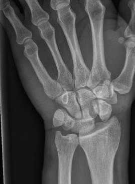 Fractures/entorses os du carpe