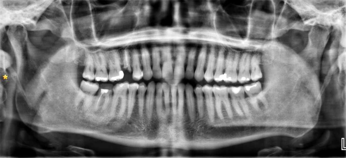 Fracture alveolo-dentaire