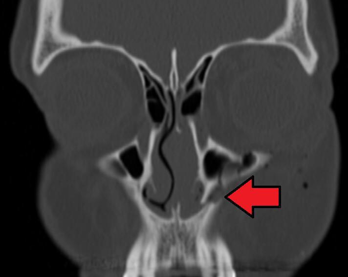 Fracture du maxillaire superieur