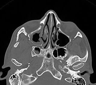 Fracture de l’os et de l’arcade zygomatique