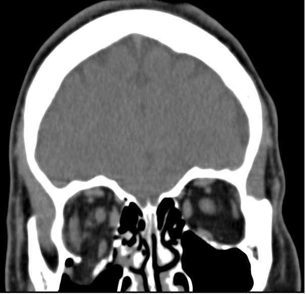 Fracture du plancher de l’orbite Fracture du plancher de l’orbite