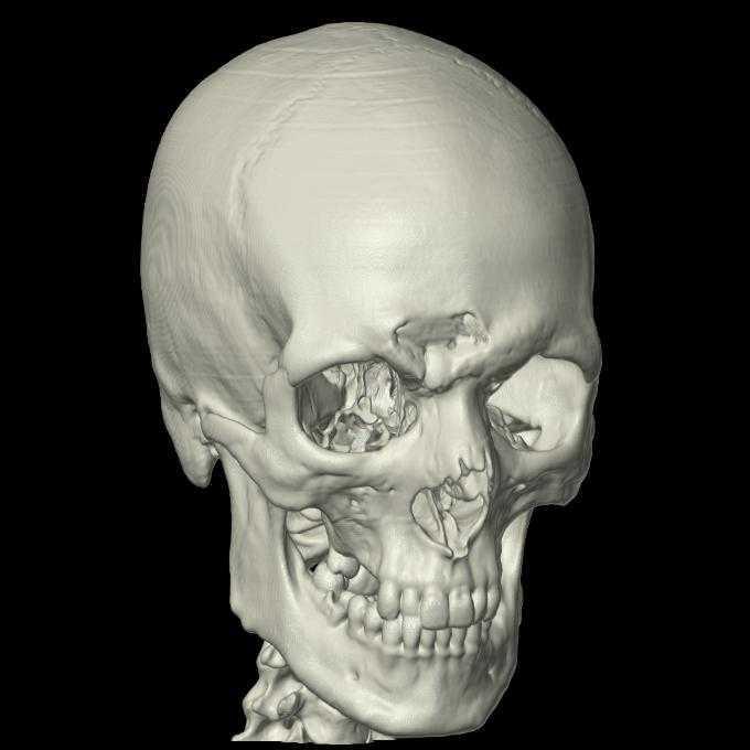 Fracture du sinus frontal