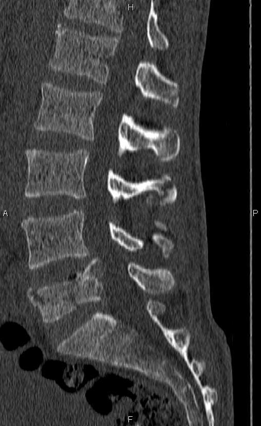 Rachis dorso-lombaire