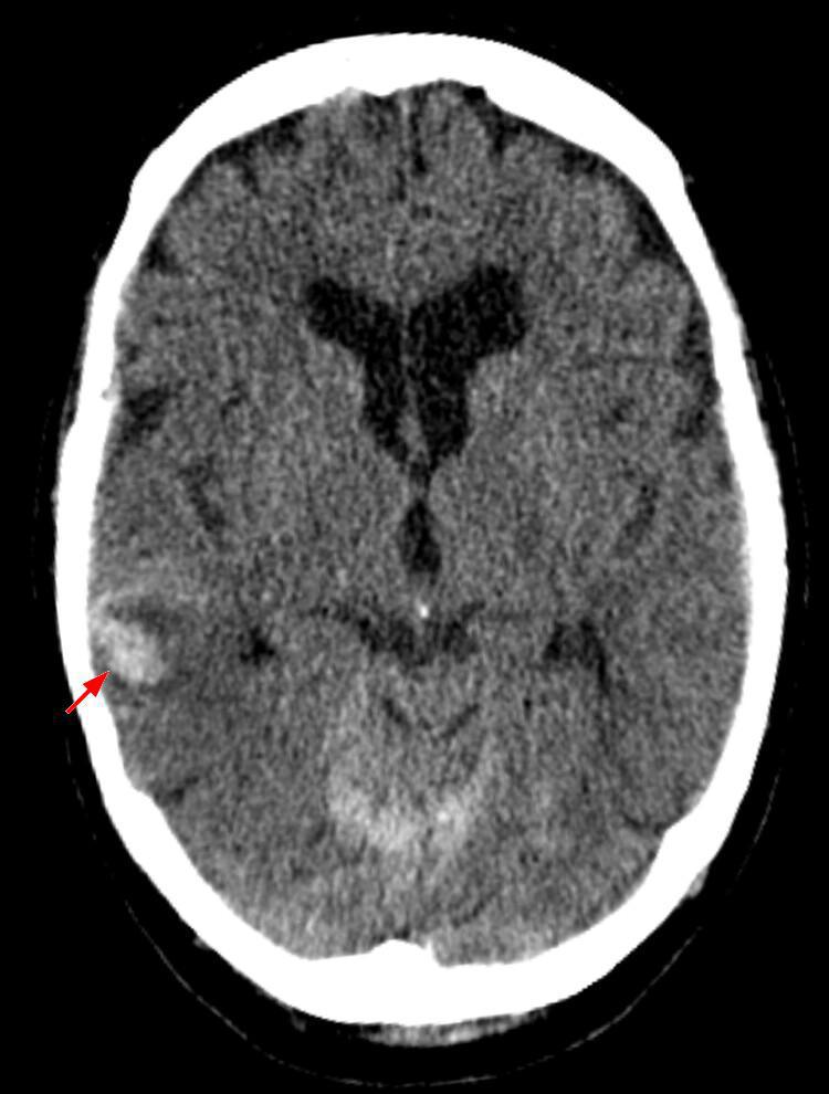 Traumatisme cranien leger