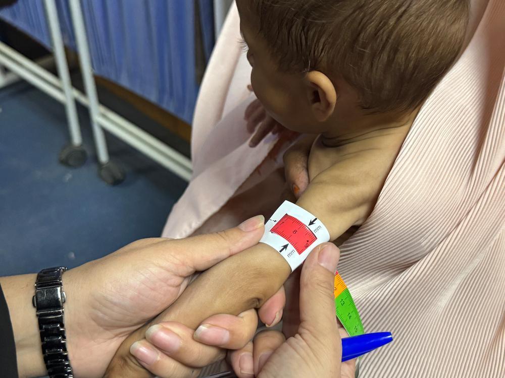 Afghanistan, allarme malnutrizione: +30% di ricoveri tra i bambini più piccoli