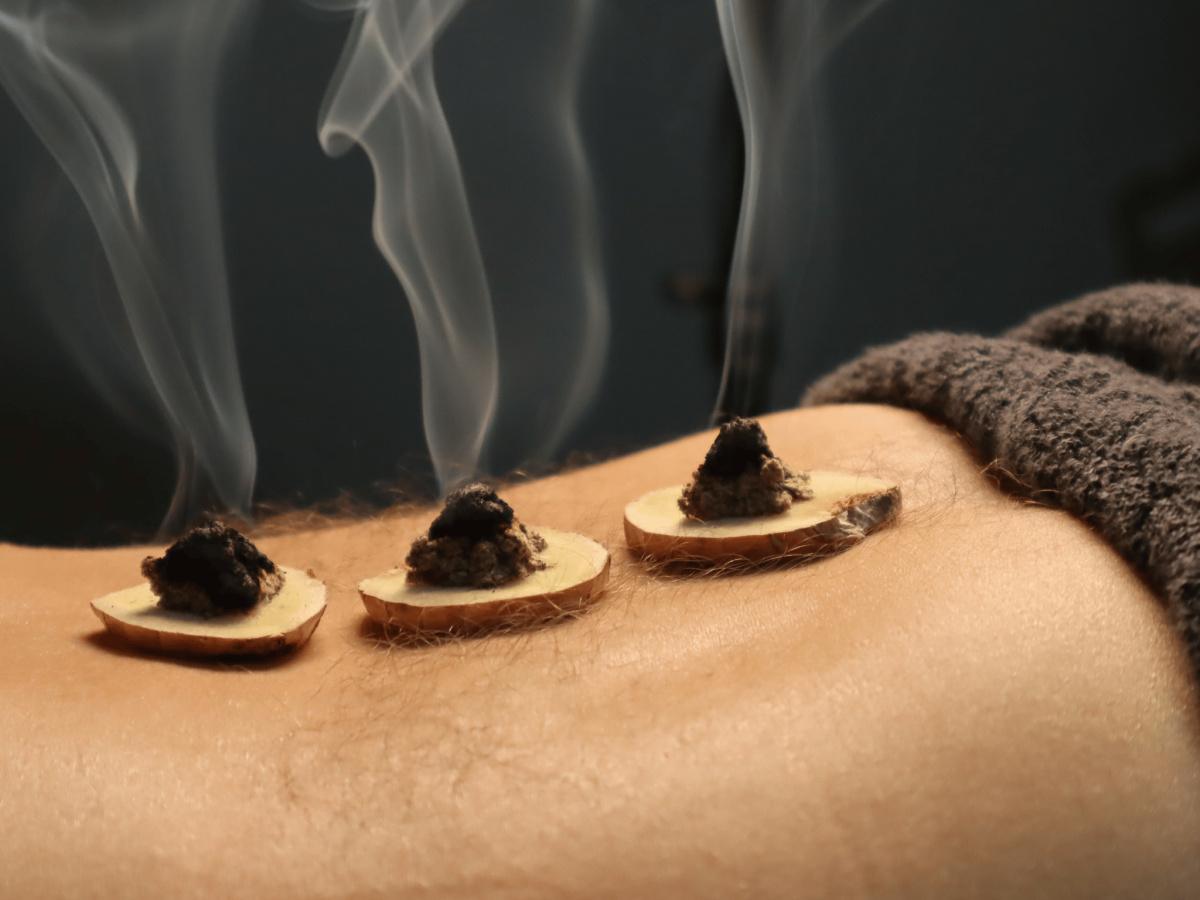 La Moxibustion