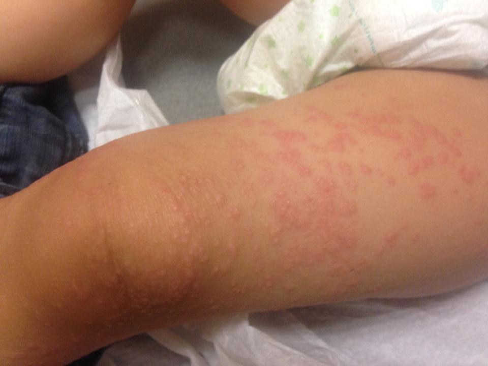 Acrodermatite érythémato-papuleuse de Gianotti