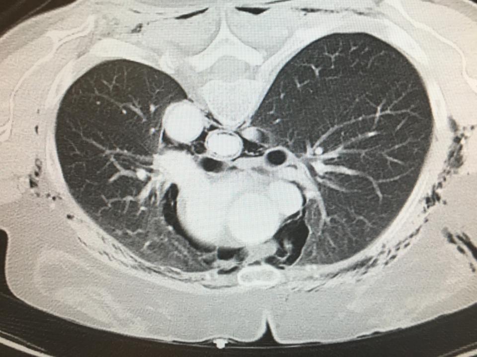 Pneumomédiastin