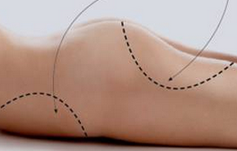 Liposuccion Genève, refaire sa silhouette
