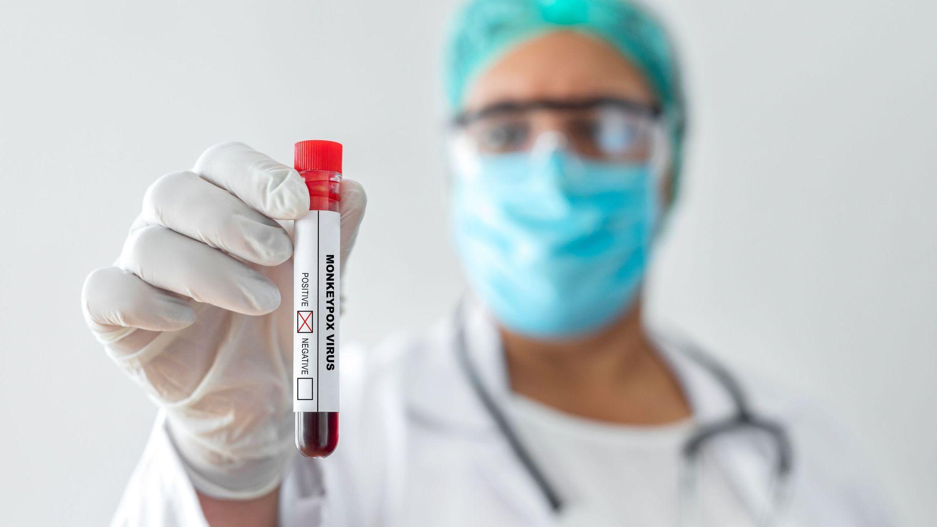 Variole du singe : La France compte désormais 91 contaminations confirmées, majoritairement chez des hommes entre 20 et 60 ans