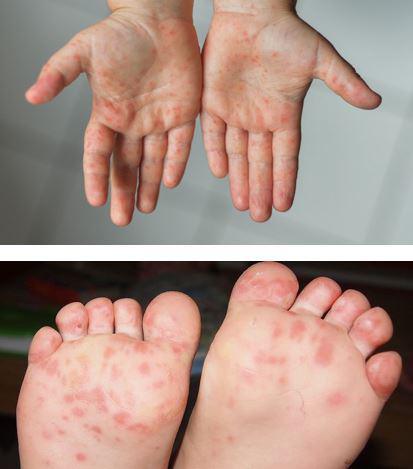 Fiche Conseil Pied Main Bouche Fiche Conseil Pied Main Bouche