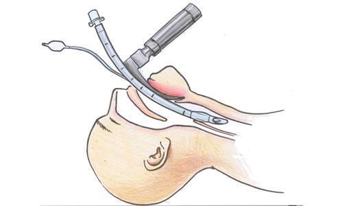 Intubation séquence rapide(ISR)