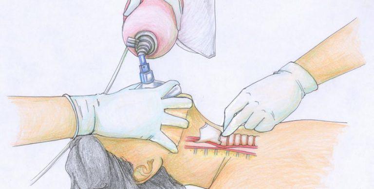 Intubation séquence rapide(ISR)