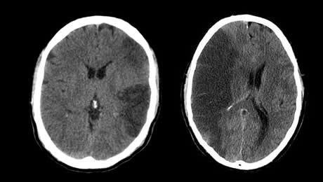 Score NIHSS simplifié (SFNV) Score NIHSS simplifié (SFNV)
