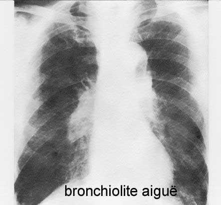 Prise en charge des BRONCHIOLITES