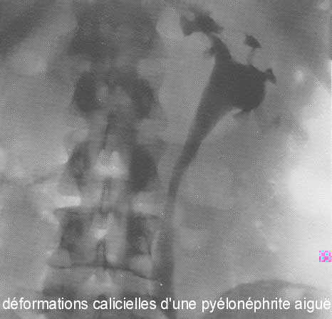 PYELONEPHRITE AIGUE