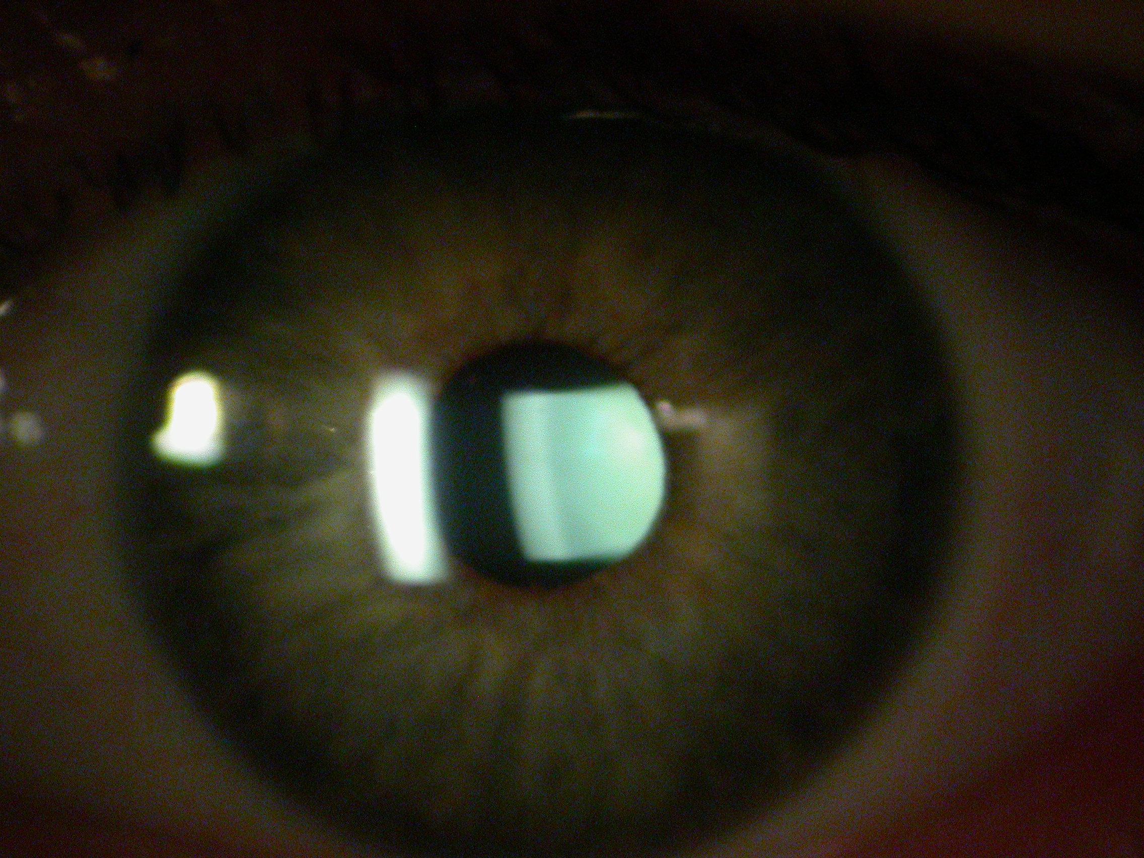 Tyndall (oeil sain)